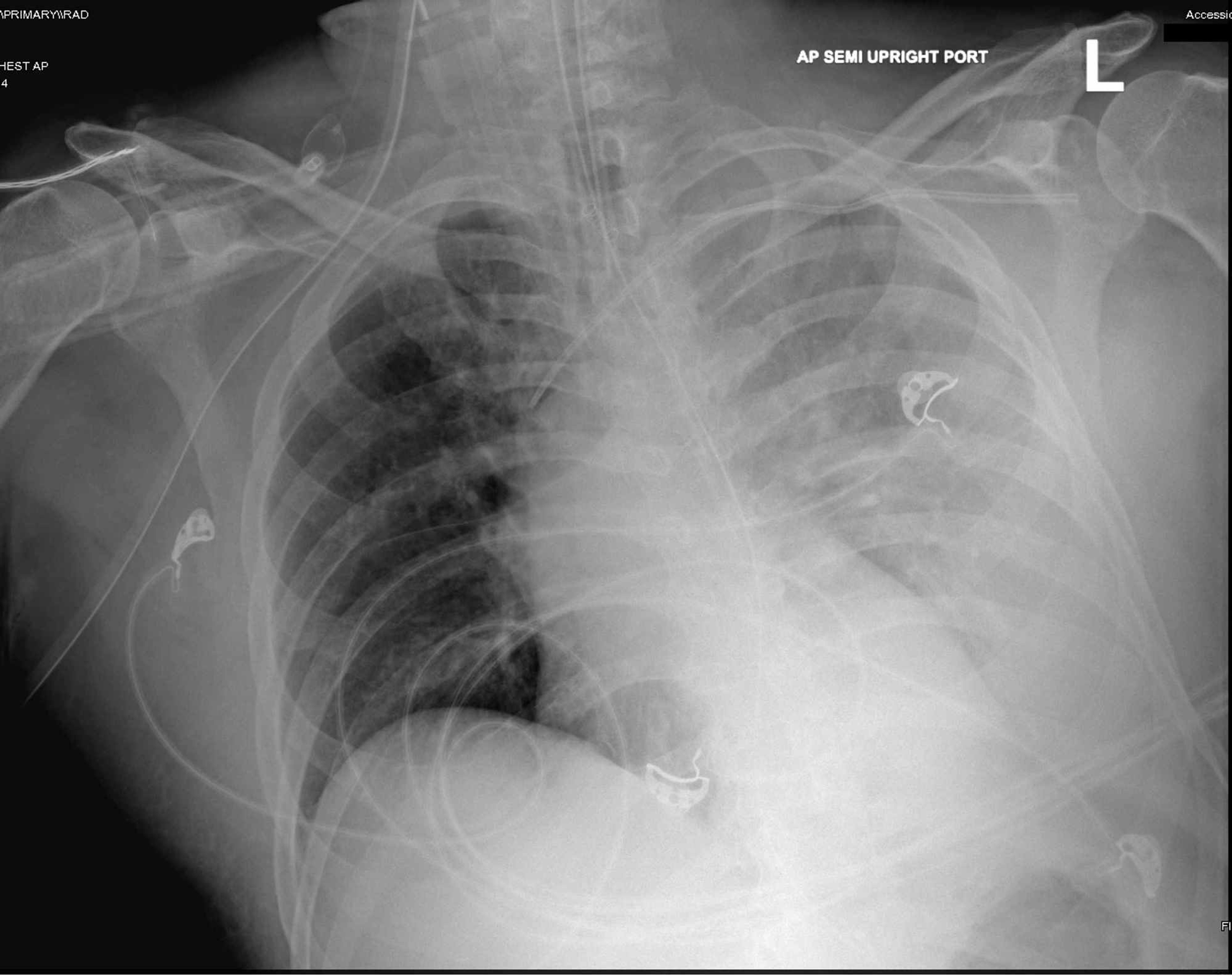 Cureus Severe Sepsis With Septic Shock as a Consequence of a Severe
