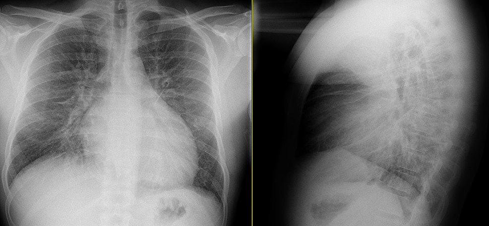 Cureus Decompensated Non Ischemic Cardiomyopathy Induced By Anabolic Androgenic Steroid Abuse
