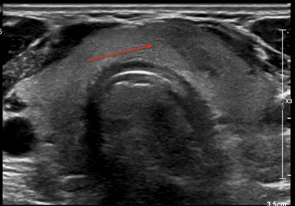 bpc 157 thyroid reddit Prolonged and Recurrent De Quervain's Thyroiditis After Thyroid Fine Needle  Aspiration