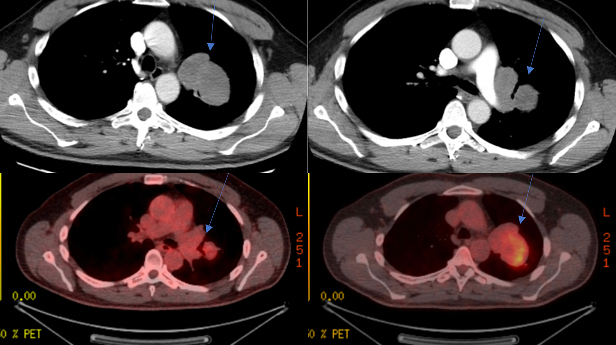 Cureus | Primary Pulmonary Synovial Sarcoma in a 49-Year-Old Male