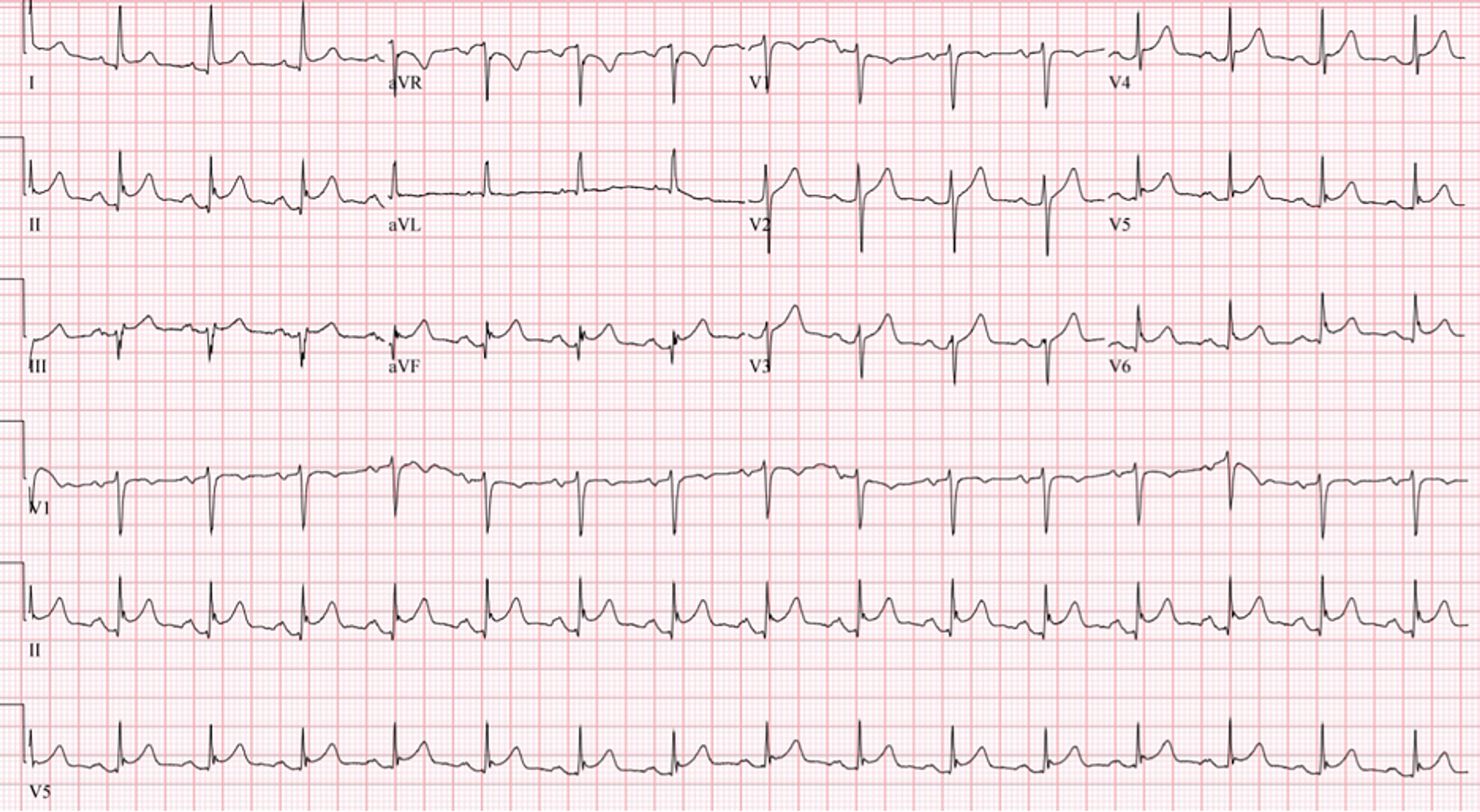 abnormal 12 lead ecg