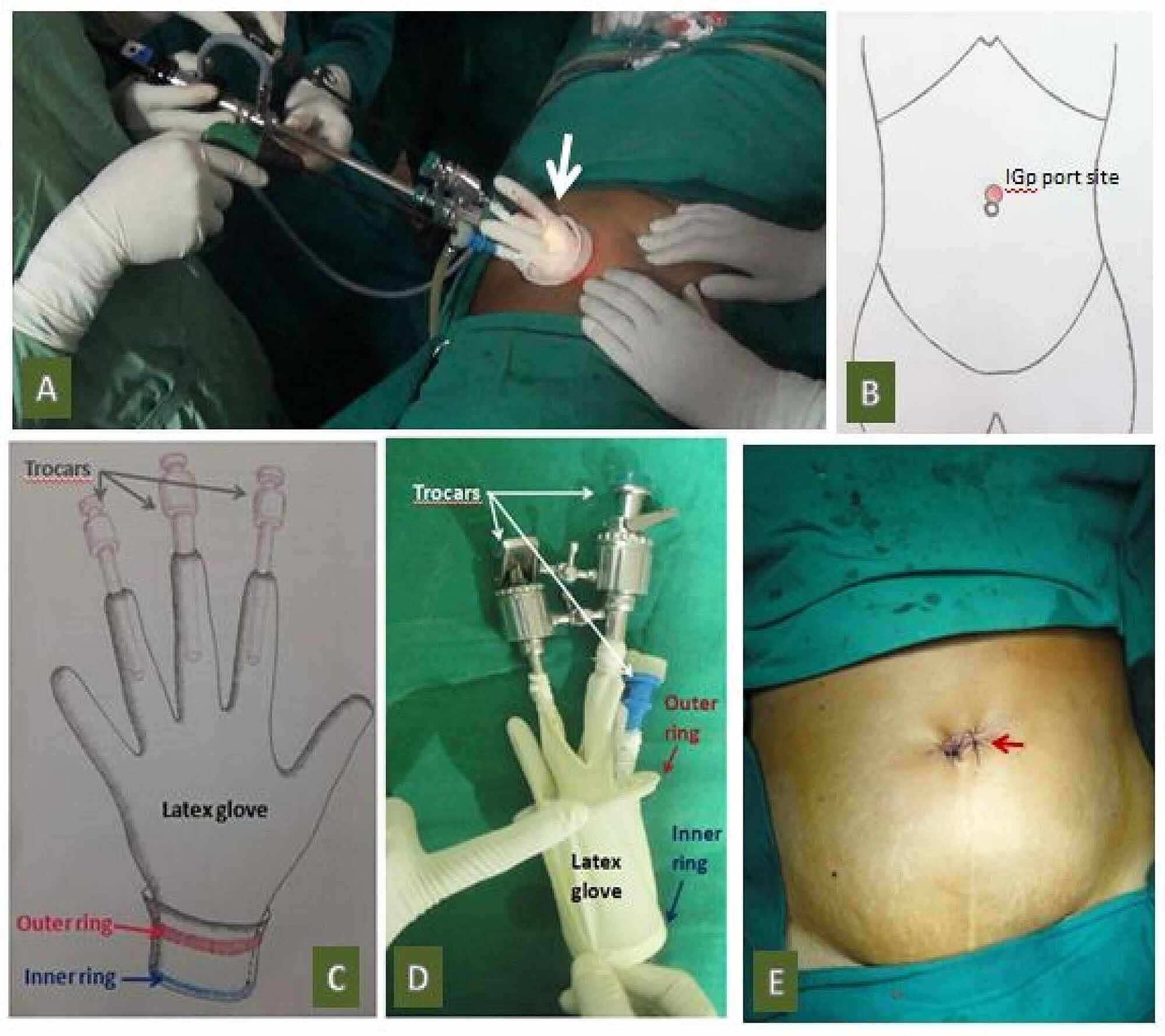Cureus A Comparative Study Between SingleIncision Laparoscopic