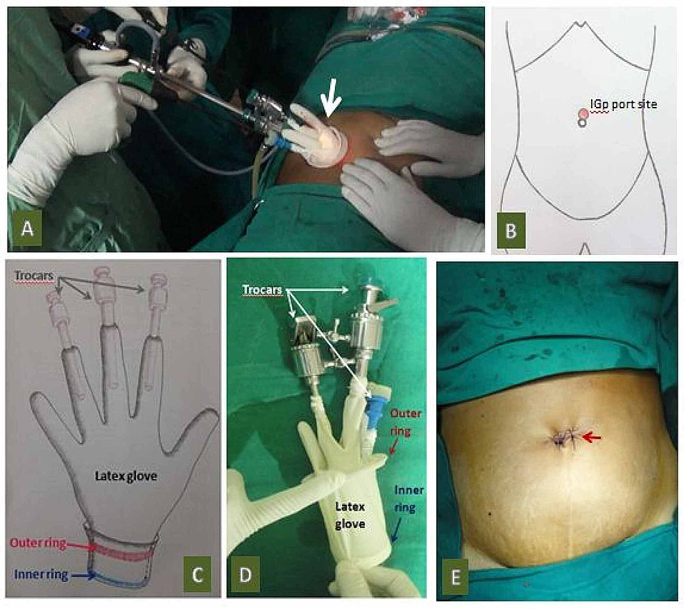 Cureus  Combined Laparoscopic Open Surgical Approach for De