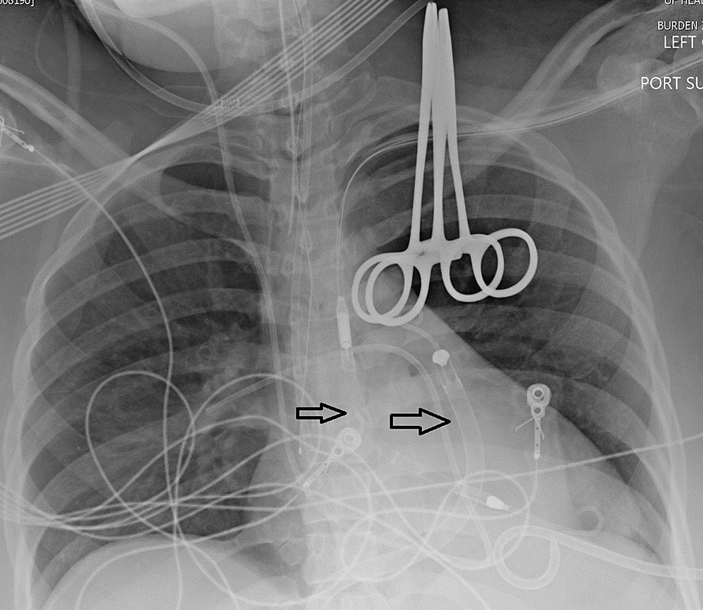 Cureus Case of Coronavirus Disease 2019 Myocarditis Managed With