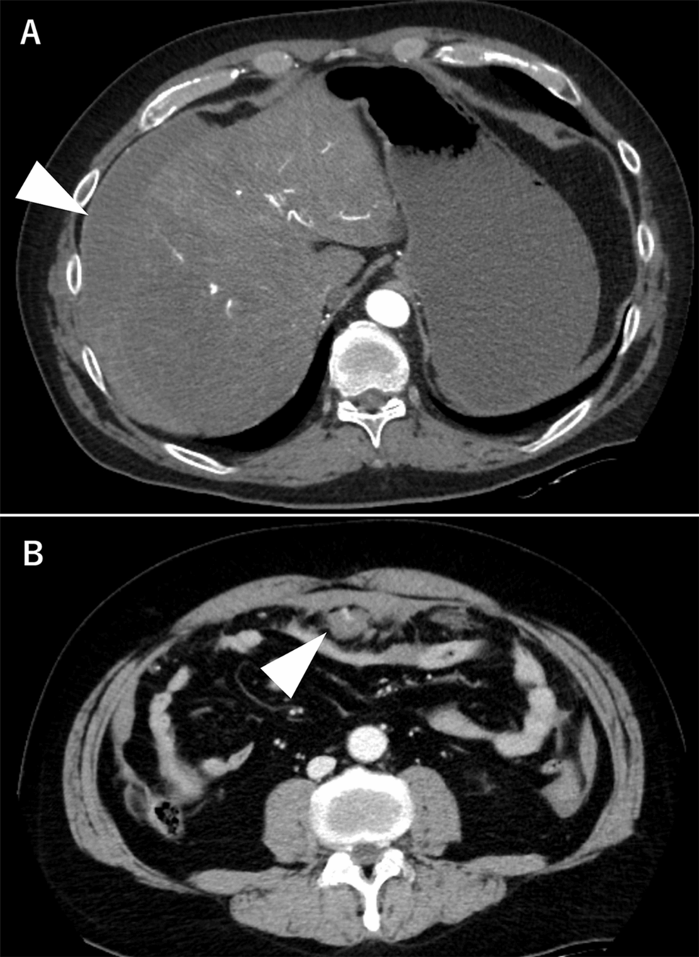 Contrast-enhanced-CT-findings-on-day-1 Contrast-enhanced-CT-findings-on-day-1