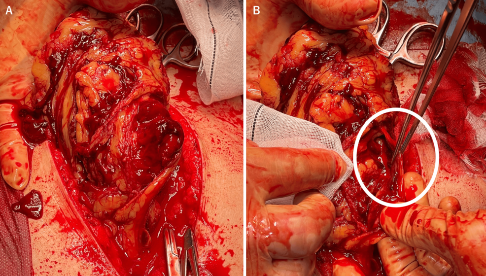 Intraoperative-findings Intraoperative-findings