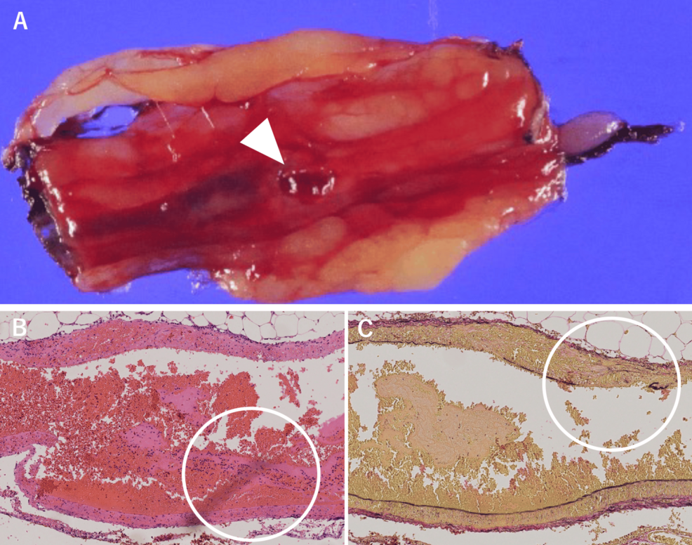 Pathological-findings Pathological-findings
