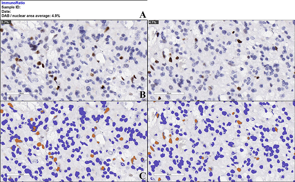 ImmunoRatio-automated-cell-counting-tool-stock-results–Ki-67-index-estimation-(DAB-indicates-the-mean-average-percentage-of-positive-nuclei-for-both-analyzed-images).