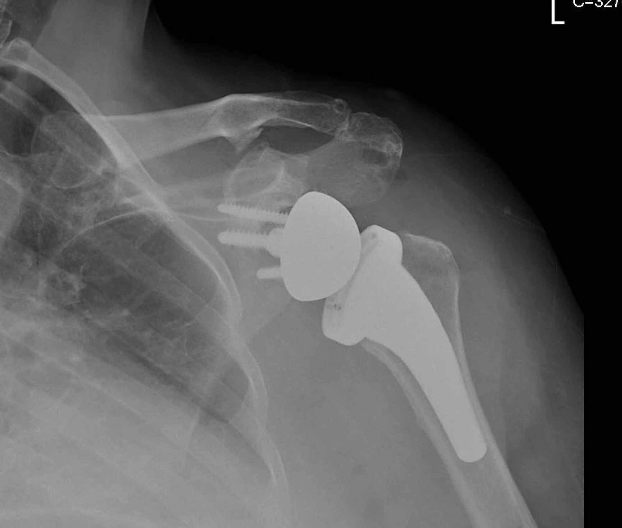 Cureus Scapular Spine Stress Fracture Following Reverse Total