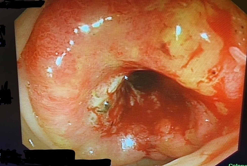 Cureus | Synchronous Colon Adenocarcinoma With Right Inguinal Lymph