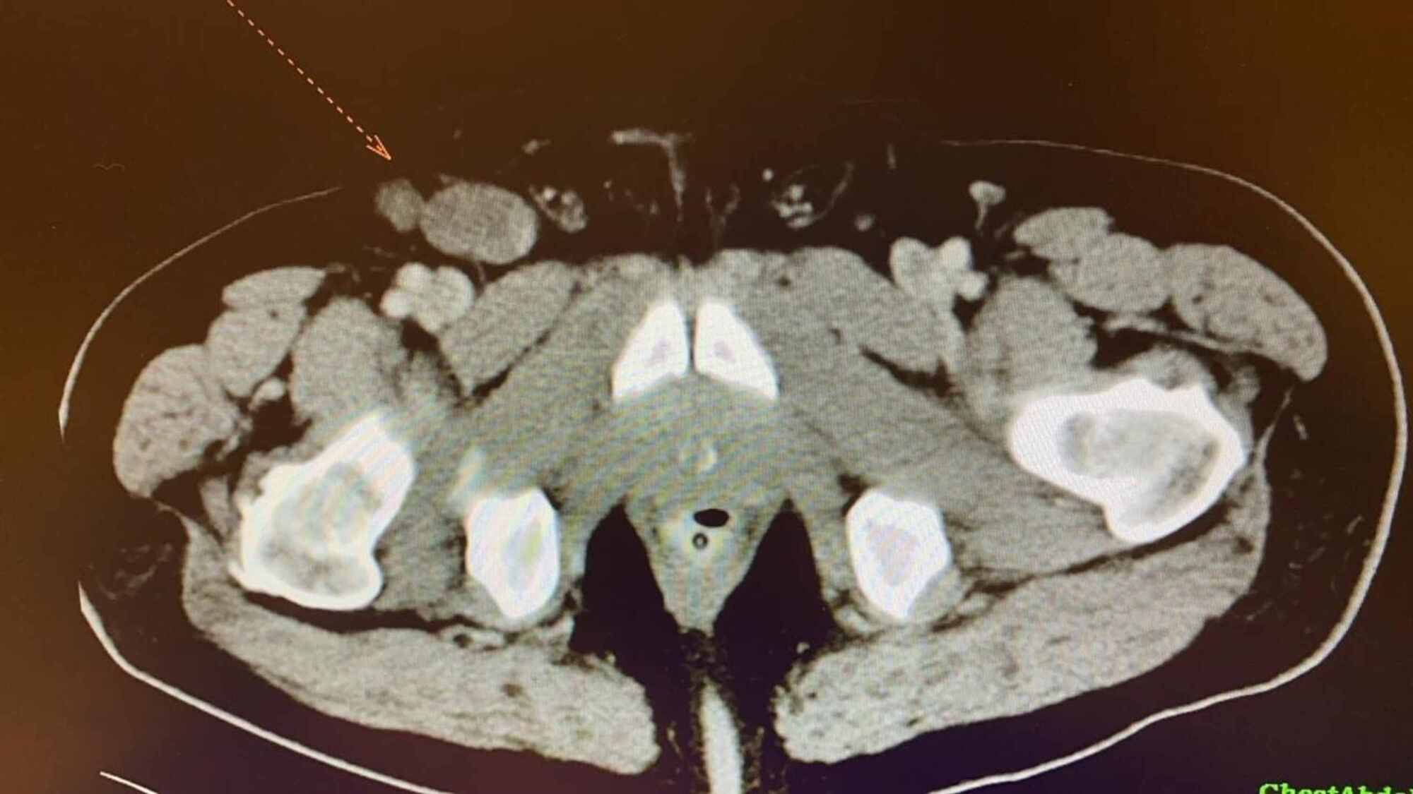 Cureus Synchronous Colon Adenocarcinoma With Right Inguinal Lymph Node Metastasis A Case 