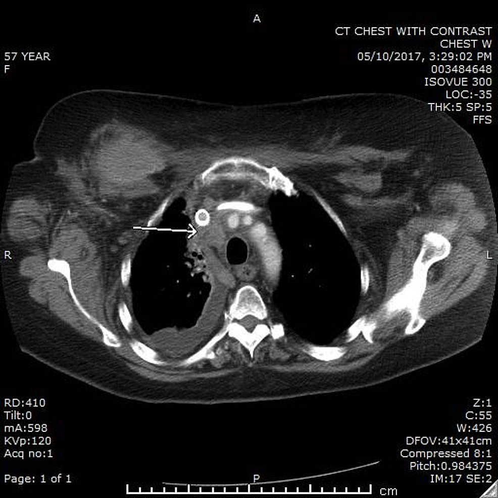 CT-chest-after-six-months-of-therapy-on-Olaparib-showing-improvement-in-the-pleural-effusion-and-lymphadenopathy