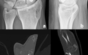 1,2 Intercompartmental Supraretinacular Artery-Based Vascularized Graft ...