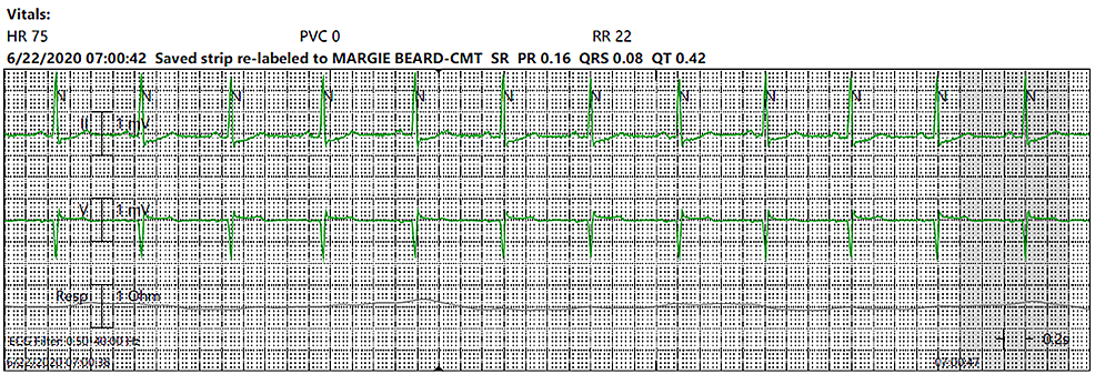 Cureus | Jaw Pain and Profound Bradycardia – An Atypical Presentation of  Lyme Carditis | Authors