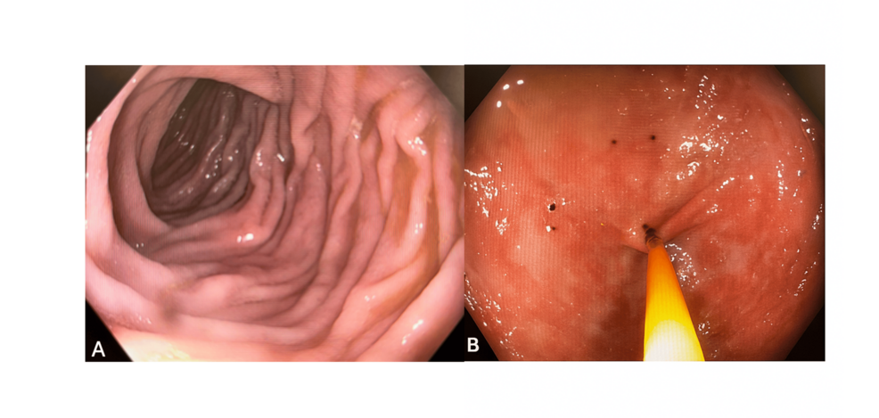 Eosinophilic Colitis in an Adult Patient: A Case Report