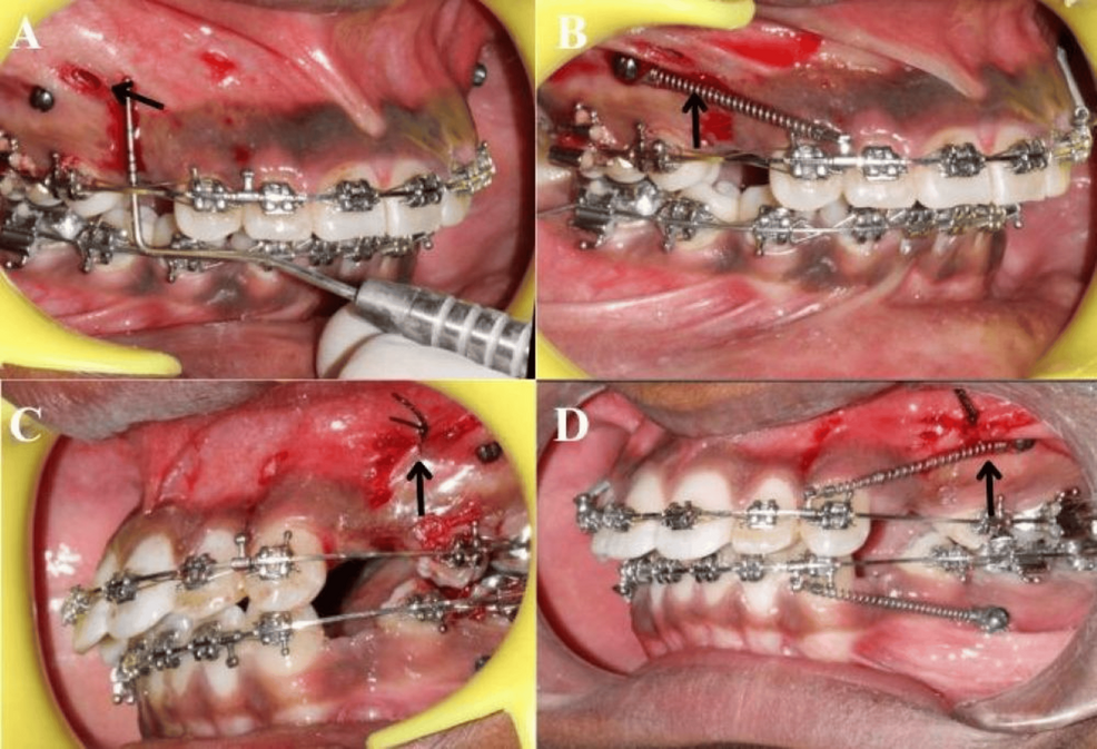 Comparison of Two Micro-osteoperforation Techniques on the Maxillary  Anterior En Masse Retraction Rate in Adults: A Split-Mouth  Quasi-experimental Study