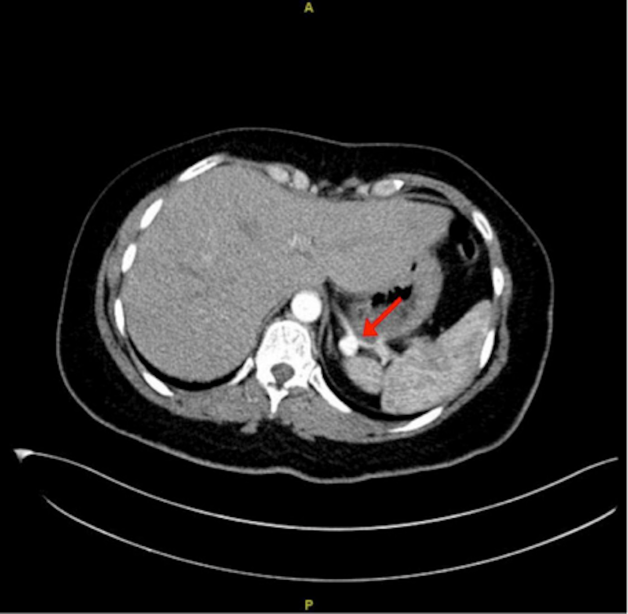 Cureus Multiple Incidental Unruptured Splenic Artery Aneurysms