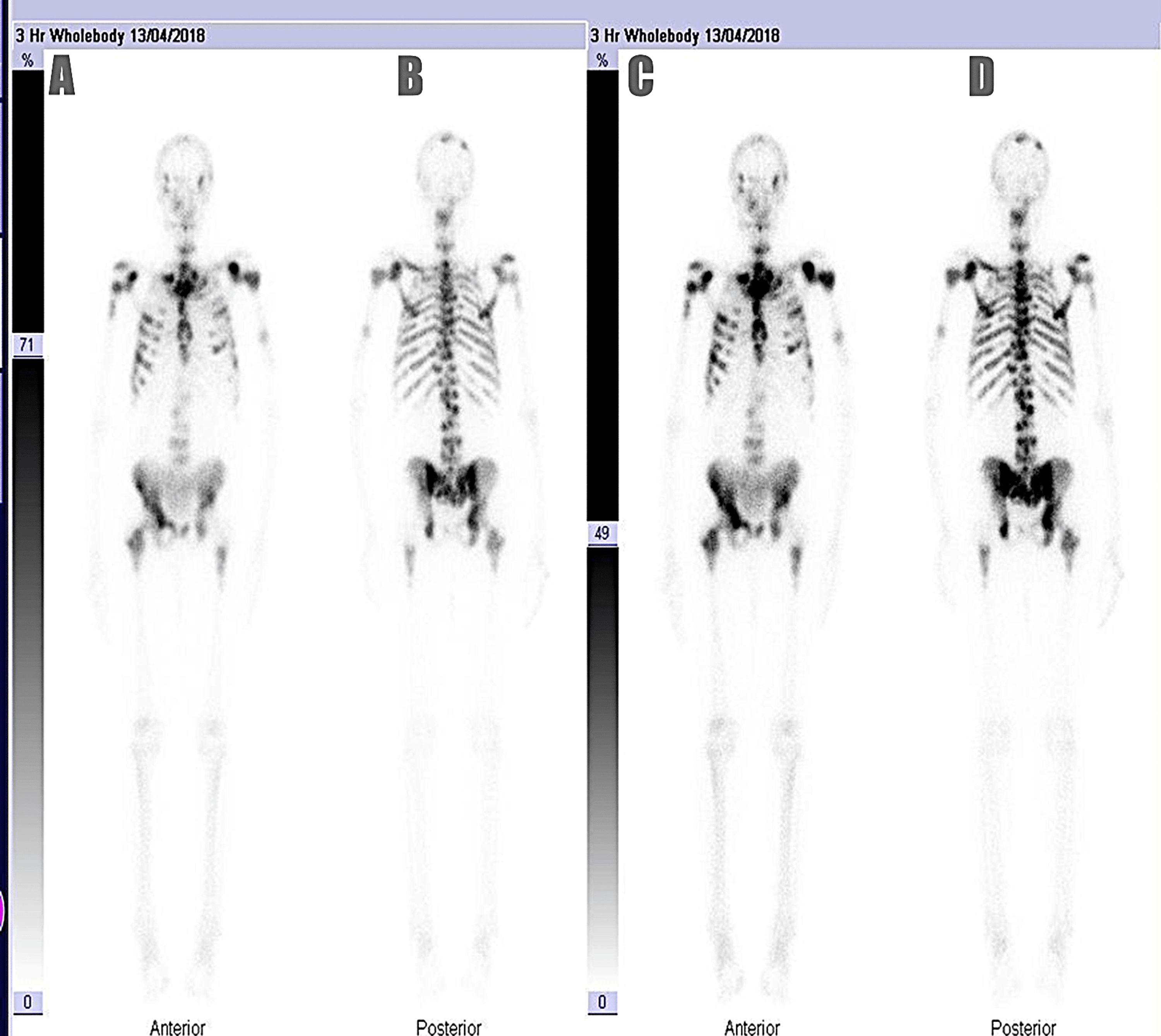 Predicting Bone Metastasis in Prostate Cancer Patients Using Total Serum  Prostate-Specific Antigen and Serum Alkaline Phosphatas, image size:3000x2679