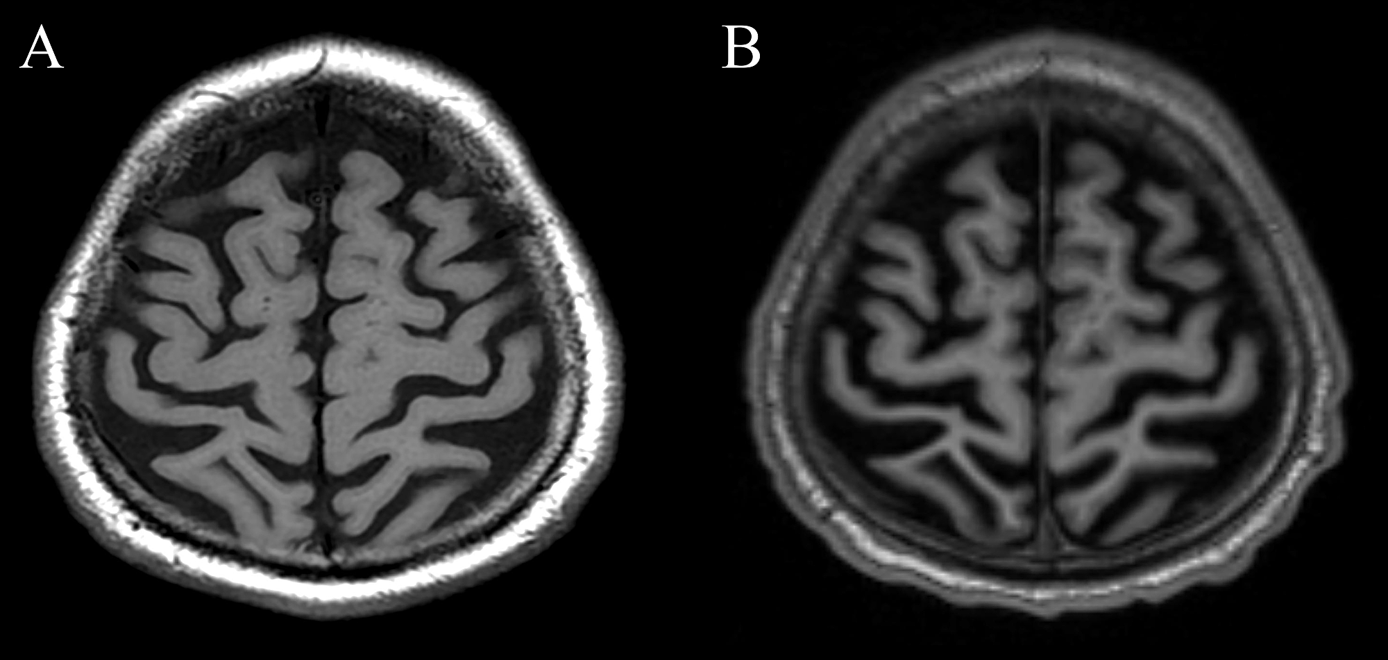 Cureus | Creutzfeldt–Jakob Disease: An Unusual Presentation Of ...