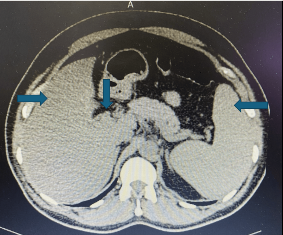 vit b12 injection for blood pressure after heart transplant Vitamin Deficiency Exhibiting as Pancytopenia: A Diagnostic Conundrum Available Options:10 mL B12 METHYLCOBALAMIN SELF INJECTION benefit-brain-health
