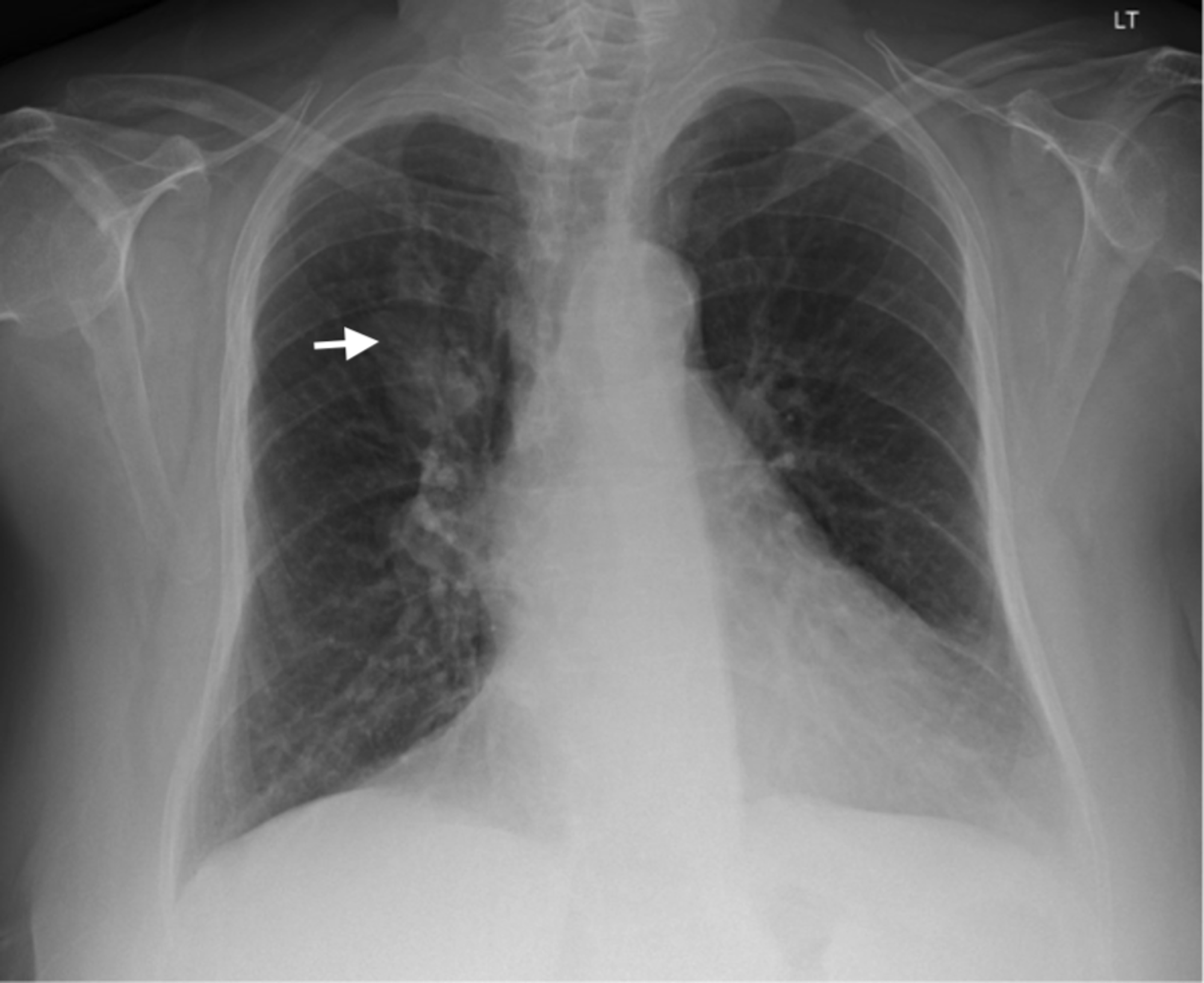 Cureus | A Case of Endobronchial Aspergilloma Coexisting With Lung ...