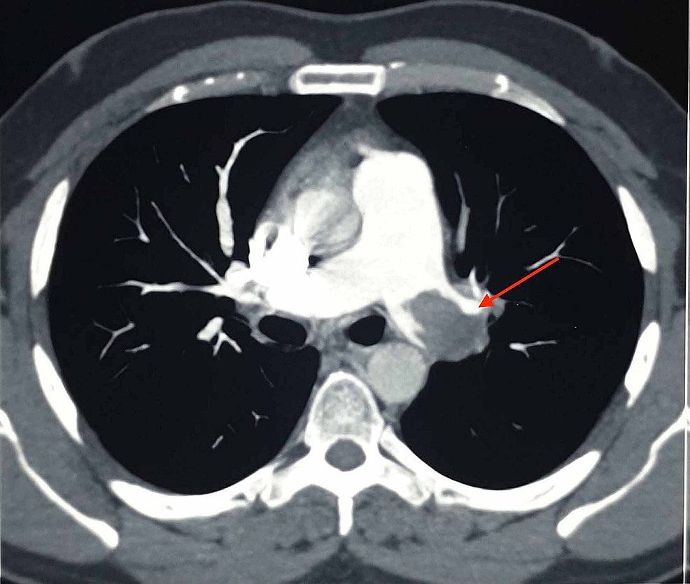 Cureus | Subacute Massive Pulmonary Embolism Treated With Streptokinase