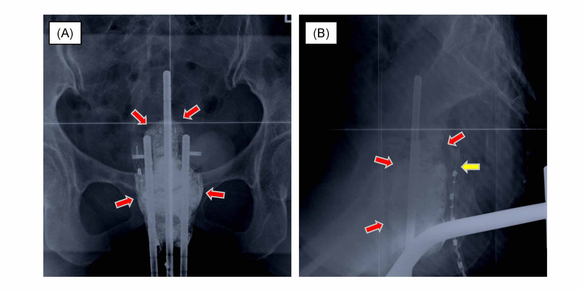 Cureus Vaginal Fistulas of the Bladder and Small Bowel After Two