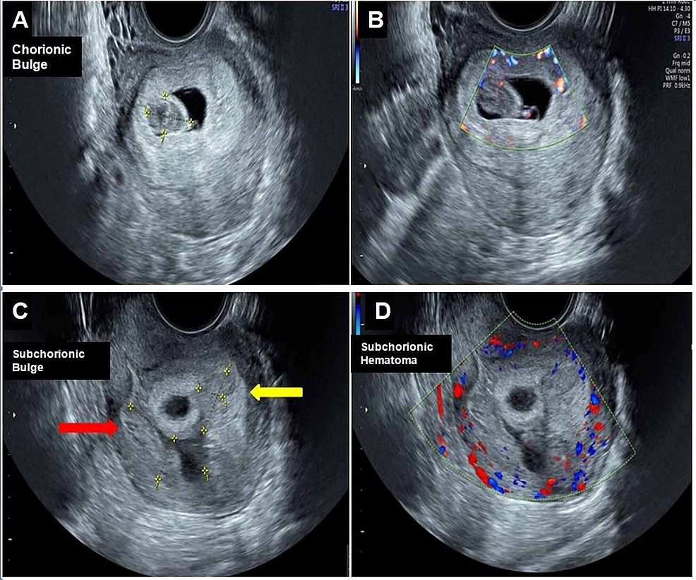 Cureus Chorionic Bump Radiologic Features And Pregnancy Outcomes