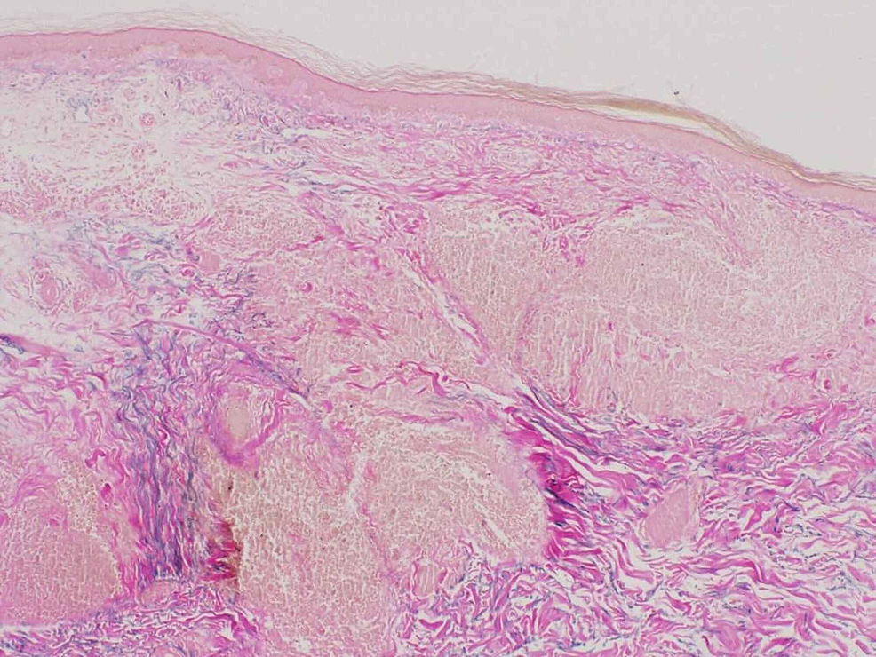 Cureus | Annular Elastolytic Giant Cell Granuloma