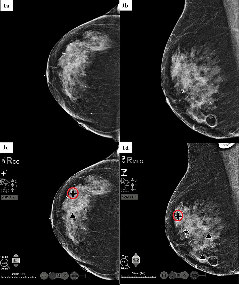 A CAD system for detection of micro calcification in breast images