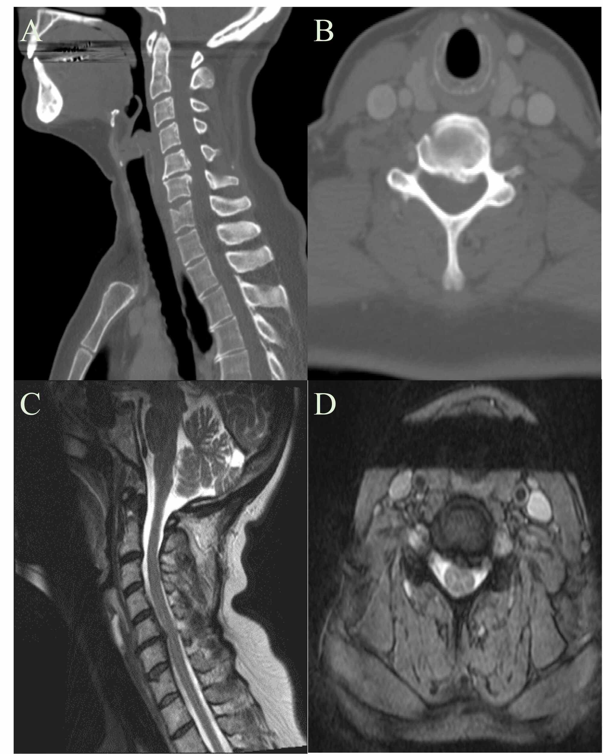 Cureus A Retrospective Pilot Study For Preoperative Screening To Prevent Iatrogenic Cervical Spinal Cord Injury