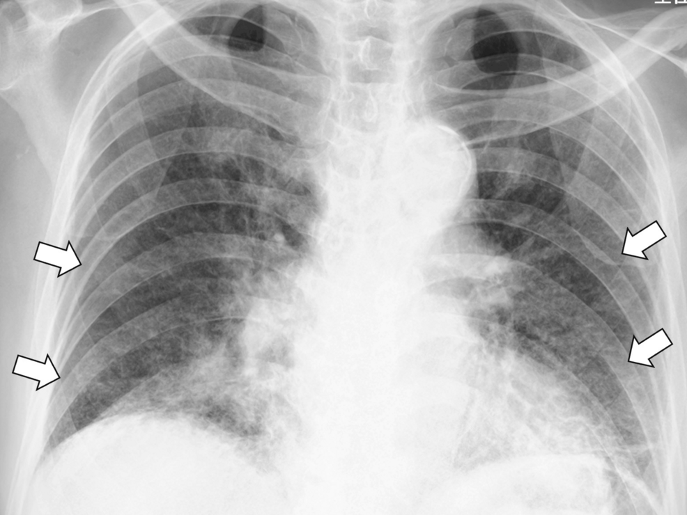 Chest-X-ray-showing-bilateral-ground-glass-opacities-in-the-lower-lung-fields-(white-arrows) Chest-X-ray-showing-bilateral-ground-glass-opacities-in-the-lower-lung-fields-(white-arrows)
