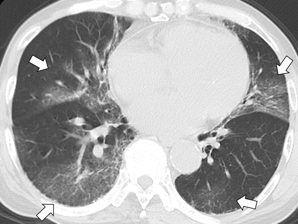Chest-computed-tomography-showing-multiple-bilateral-subpleural-ground-glass-opacities-(white-arrows) Chest-computed-tomography-showing-multiple-bilateral-subpleural-ground-glass-opacities-(white-arrows)