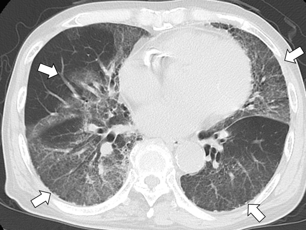 Chest-computed-tomography-showing-worsening-bilateral-infiltrates,-suggestive-of-acute-respiratory-distress-syndrome-(white-arrows) Chest-computed-tomography-showing-worsening-bilateral-infiltrates,-suggestive-of-acute-respiratory-distress-syndrome-(white-arrows)