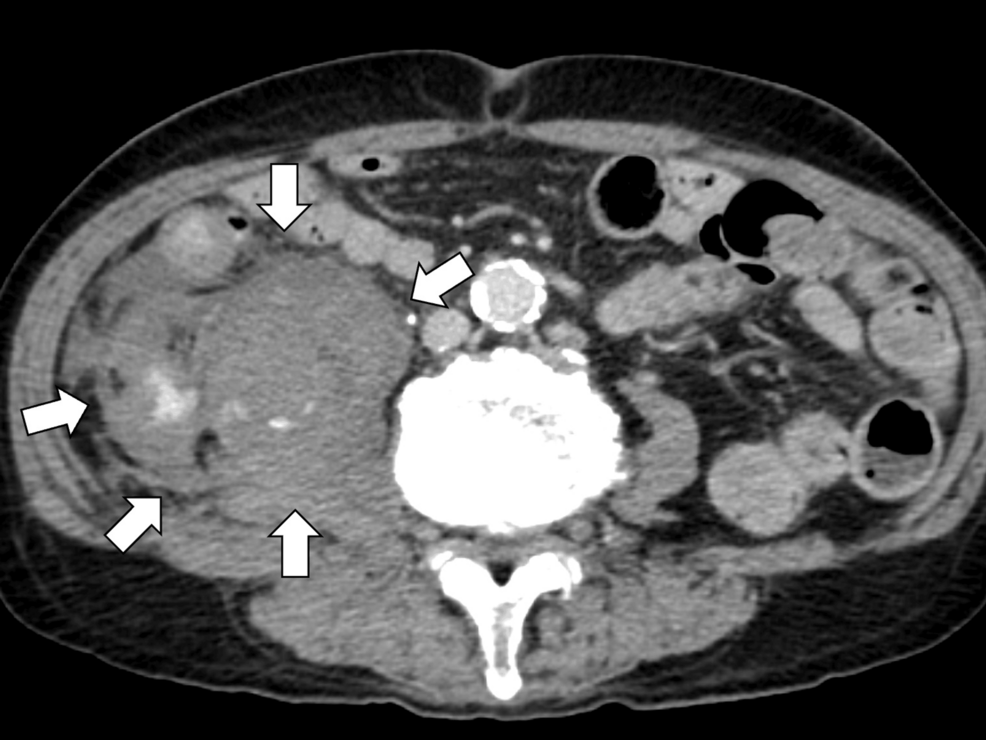 Contrast-enhanced-computed-tomography-showing-active-extravasation-in-the-right-iliopsoas-muscle-(white-arrows) Contrast-enhanced-computed-tomography-showing-active-extravasation-in-the-right-iliopsoas-muscle-(white-arrows)