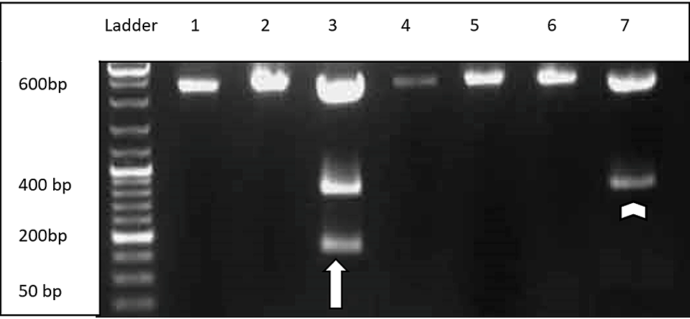 Agarose-gel-electrophoresis-showing-FoK-I-and-Nla-III-restriction-site-indicating-376-A→G-mutation-(white-arrowhead)-and-G6PD-A(-)-202A/376G-mutation-(white-arrow)