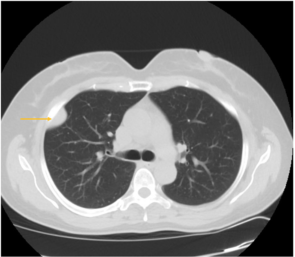 Cureus | Solitary Fibrous Tumors of the Pleura