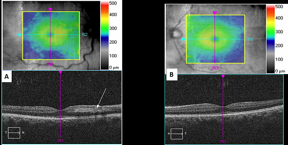 Optical-Coherence-Tomography-Macula