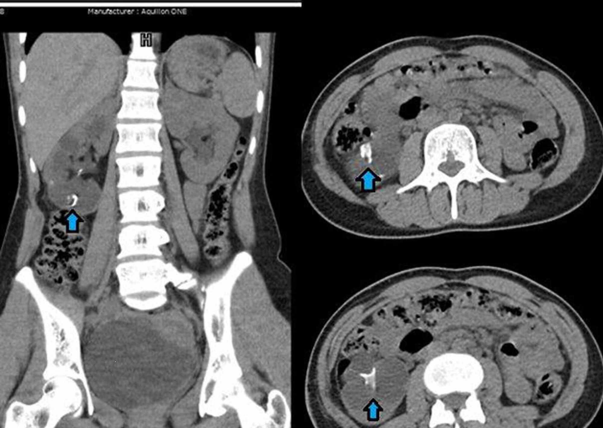 Cureus Foreign Body in Kidney Presenting as Renal Stone