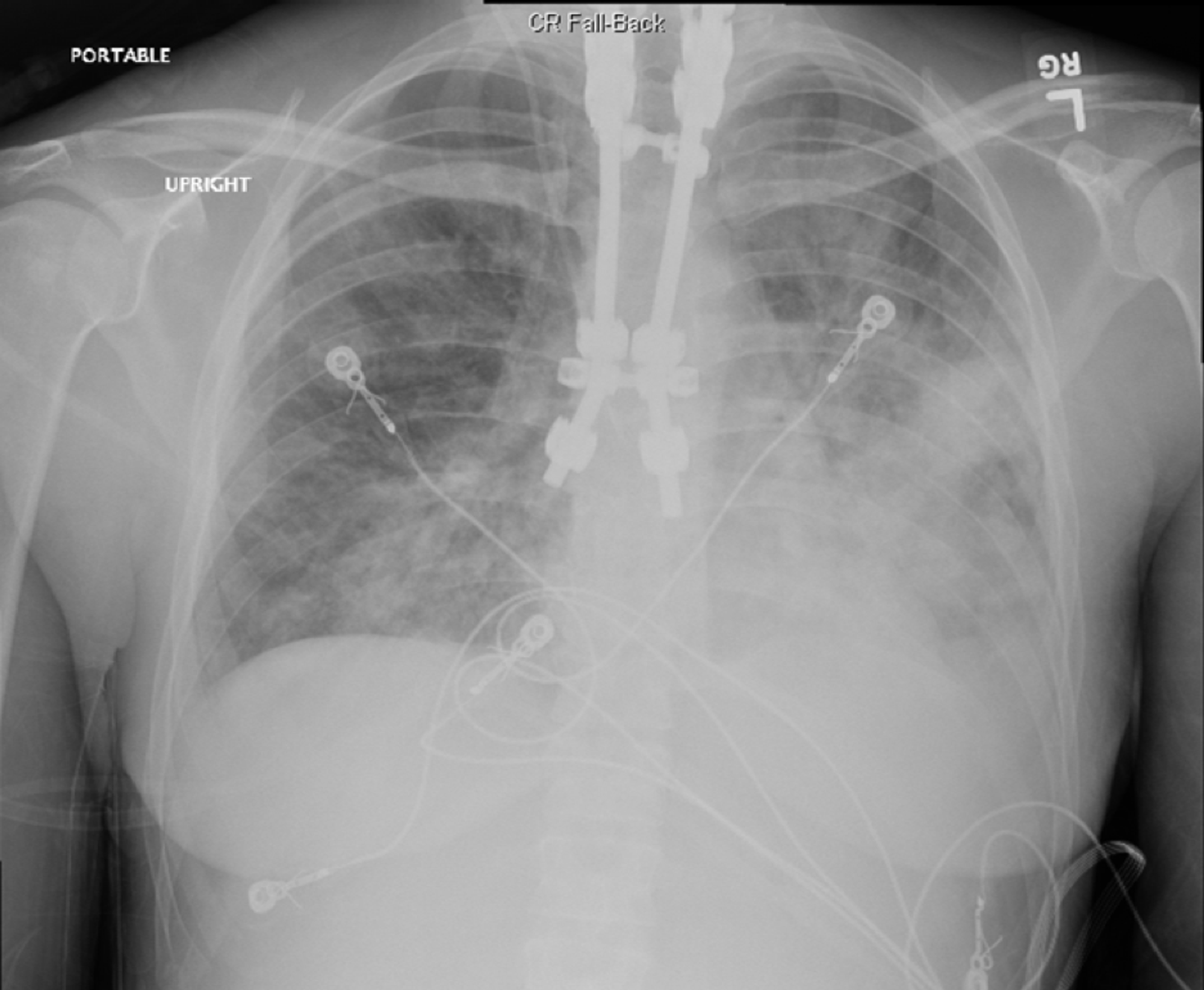 Cureus | Acute Hypoxic Respiratory Failure and Septic Shock Secondary ...