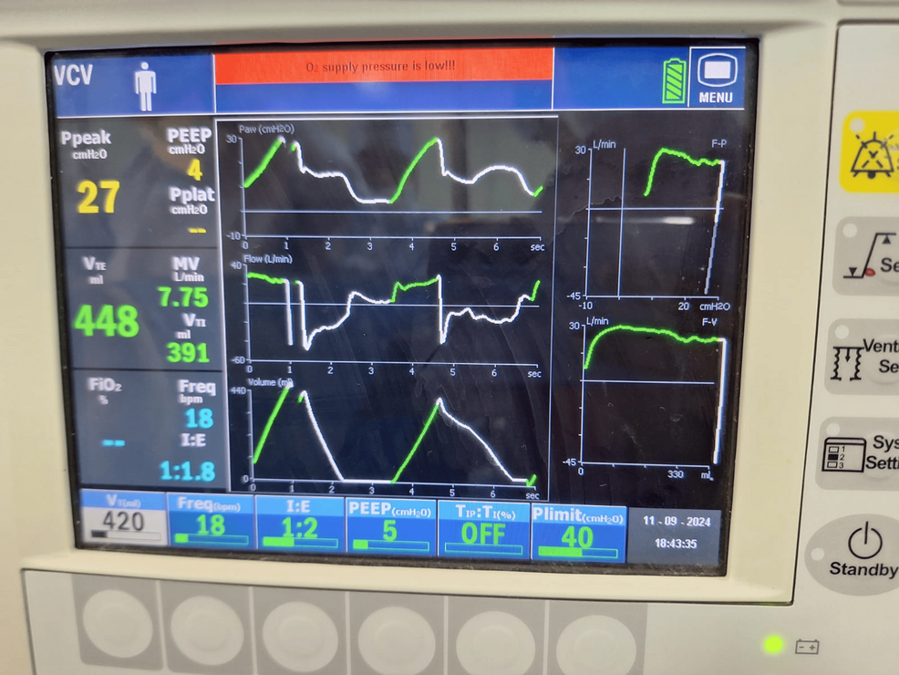 Presence-of-spontaneous-breathing-during-volume-controlled-ventilation