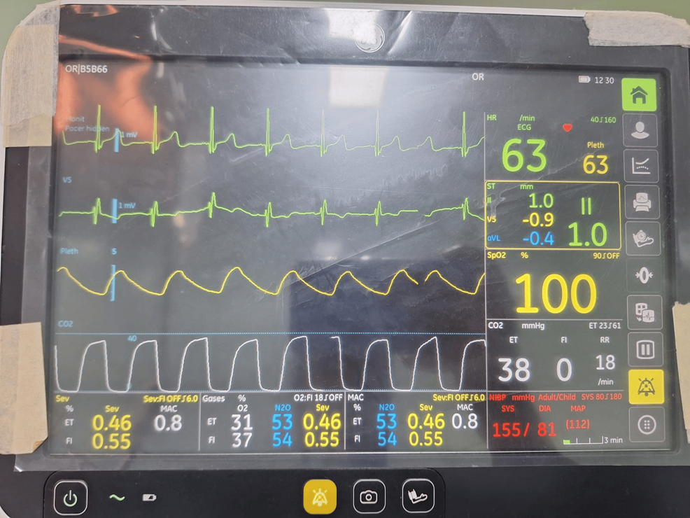 Absence-of-curare-clefts-on-capnography-after-achieving-adequate-depth-of-anesthesia