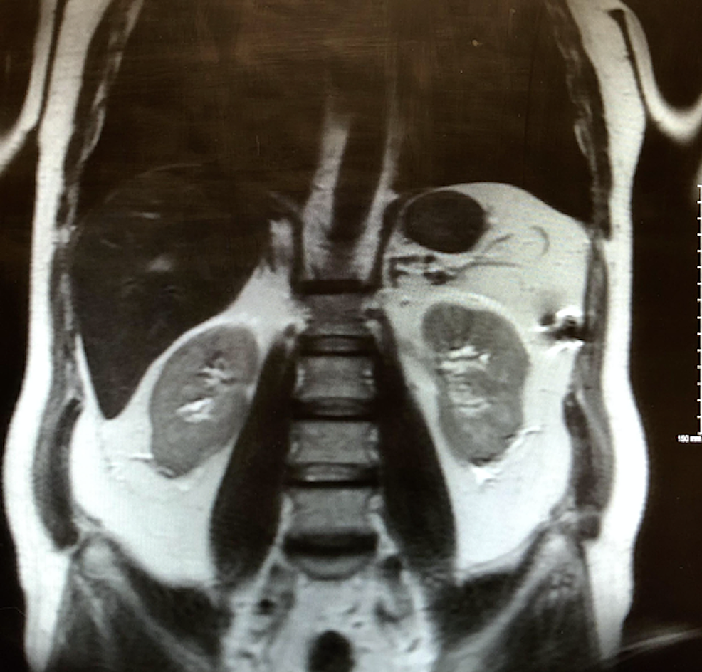 MRI-abdomen-showing-no-evidence-for-renal-cell-carcinoma