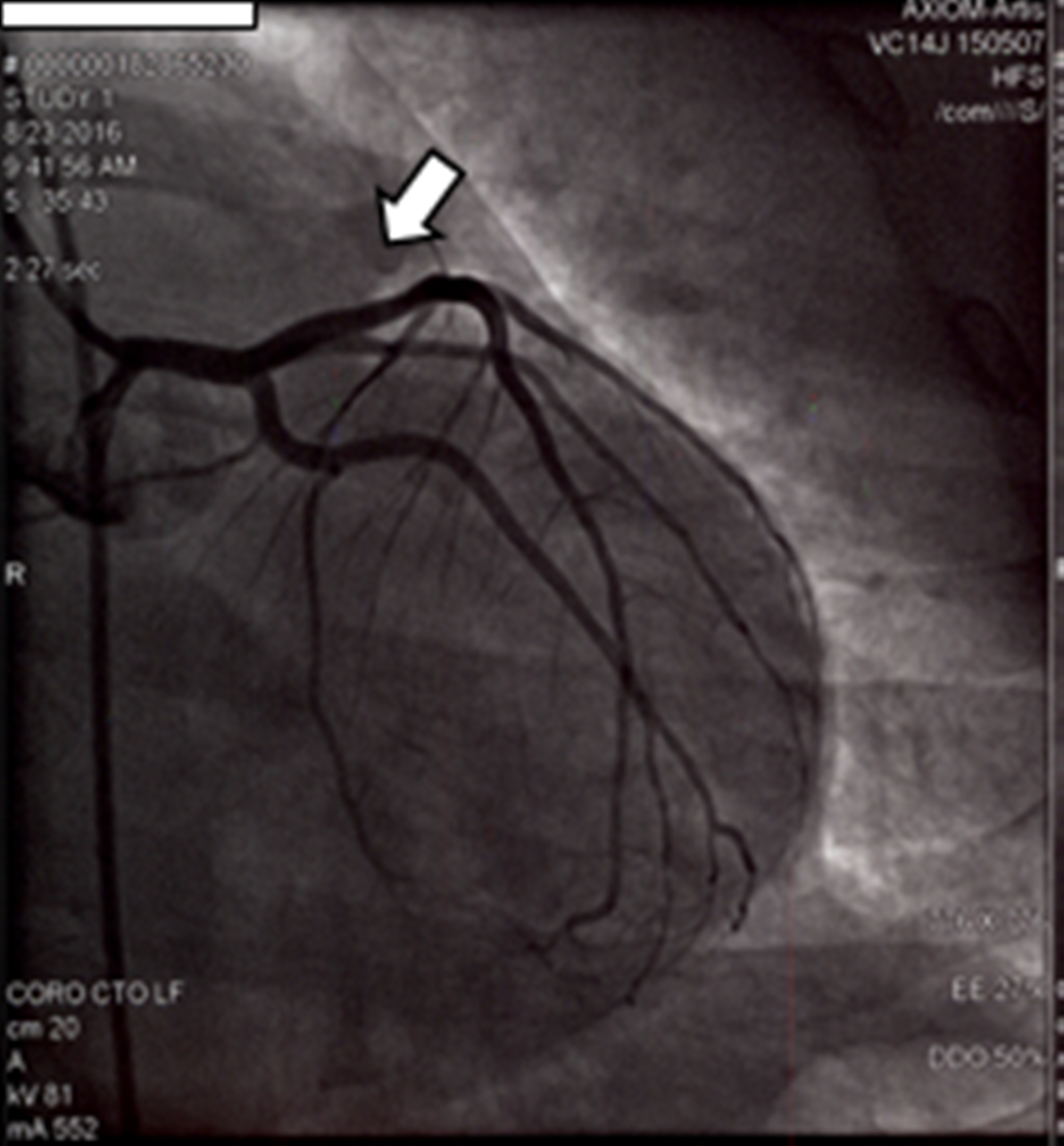 Cureus | Acute Myocardial Infarction in Young Systemic Lupus Erythematosus Patient with Normal ...