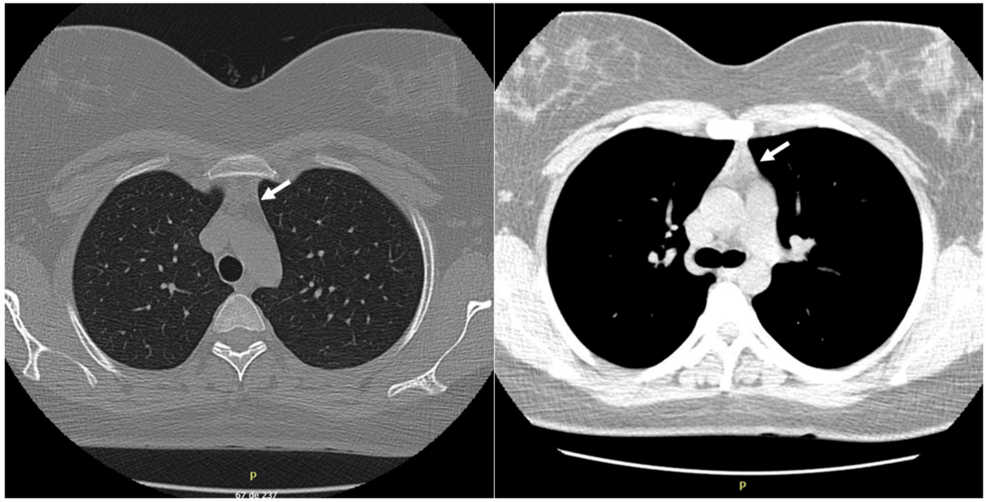 Early Myasthenia Gravis Activities of Daily Living (MG-ADL