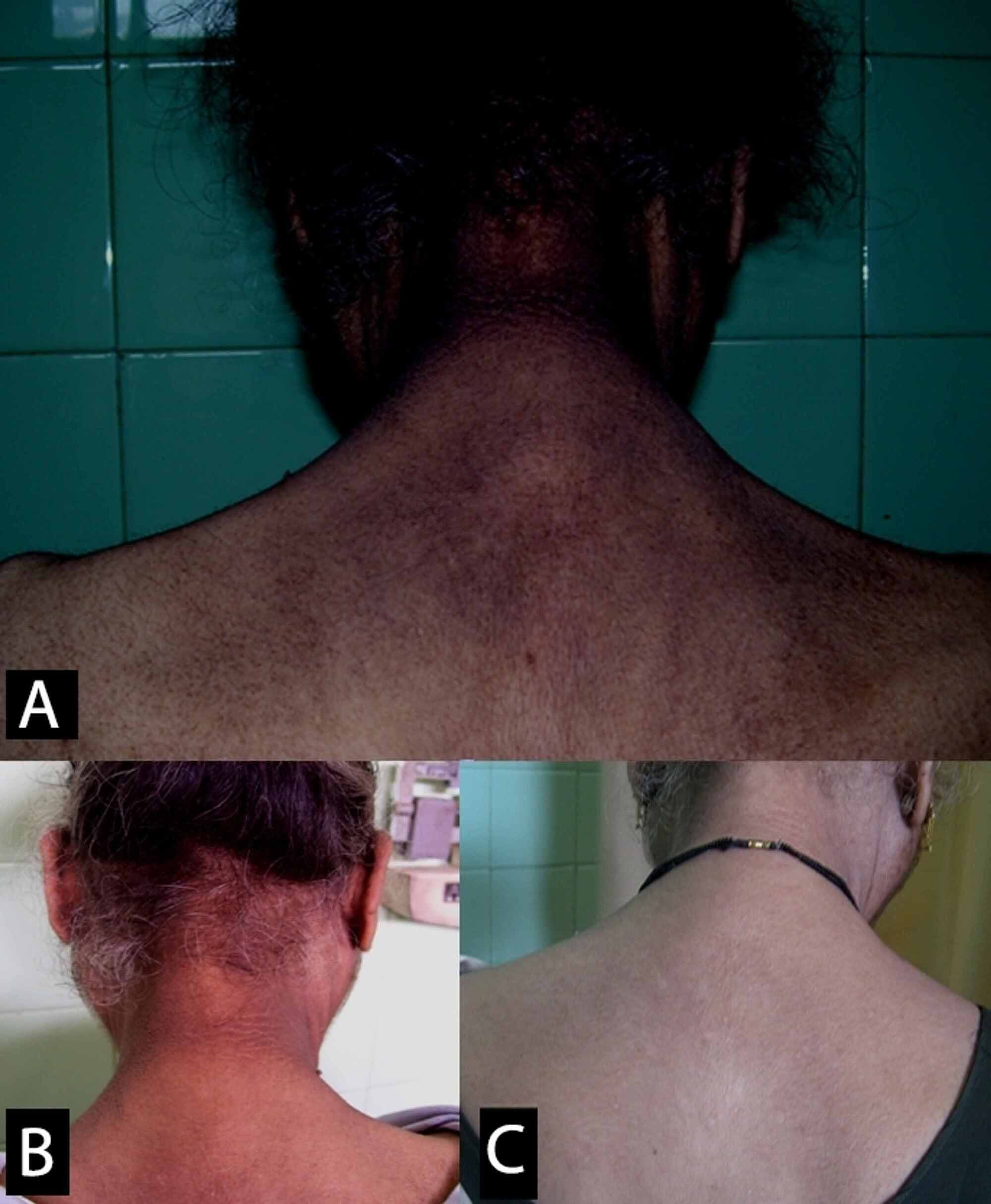 Treatment acanthosis nigricans Acanthosis Nigricans: