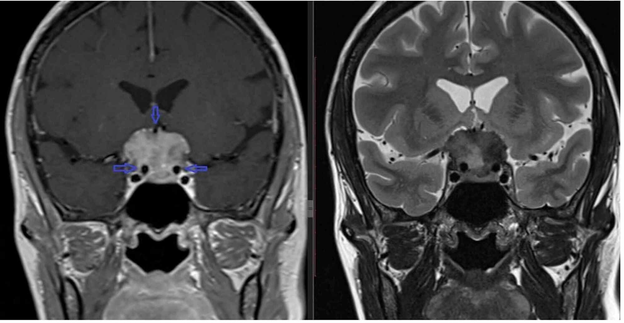 Can An Xray Show A Brain Tumor In A Dog