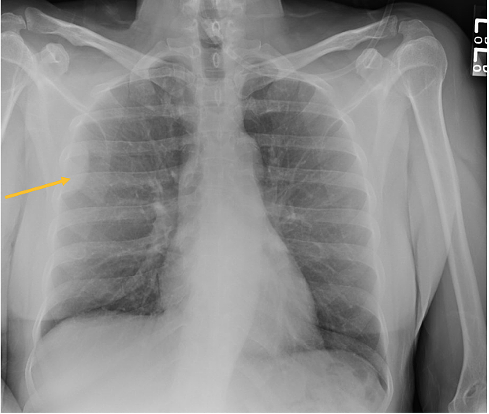 Cureus Solitary Fibrous Tumors Of The Pleura