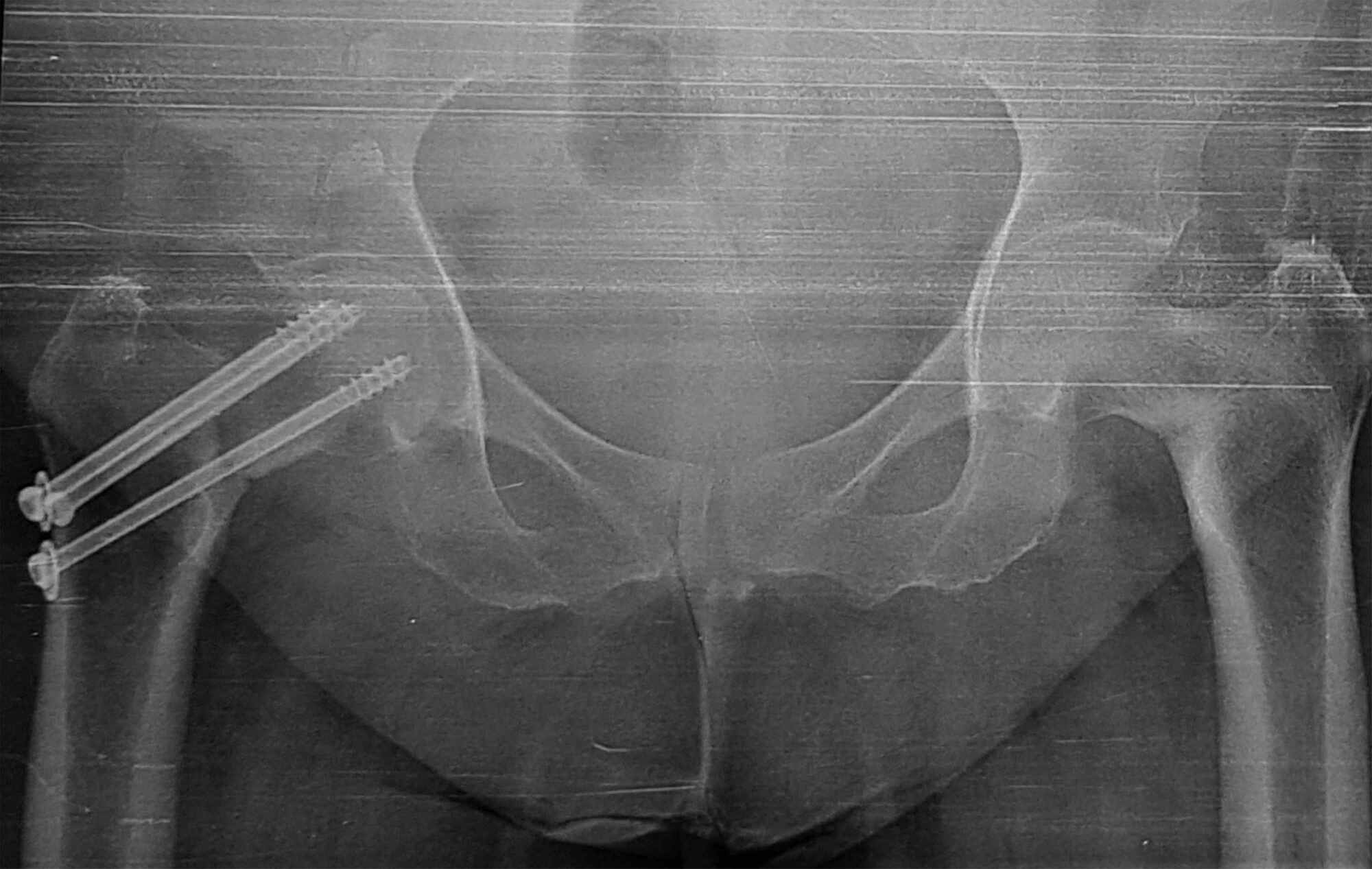 femoral neck fracture fixation
