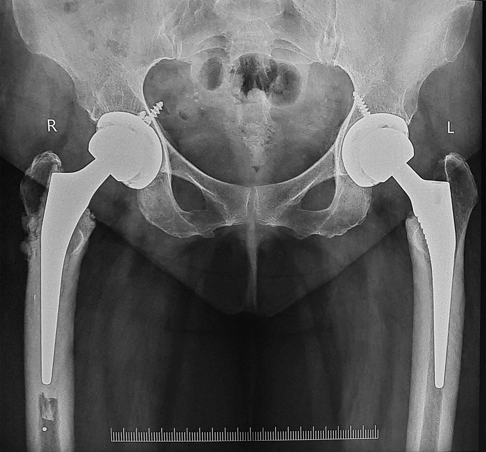 Cureus Bilateral Femoral Neck Stress Fracture In An Obese Middle Aged